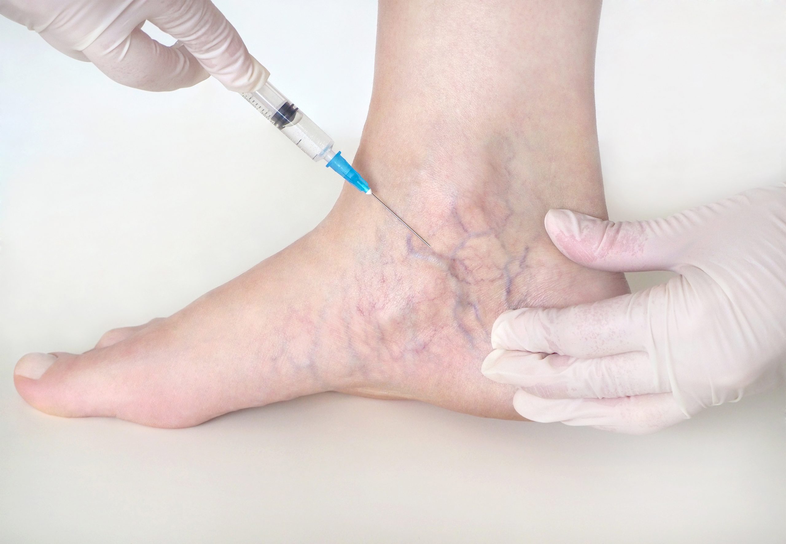 Clínica vascular en Las Palmas