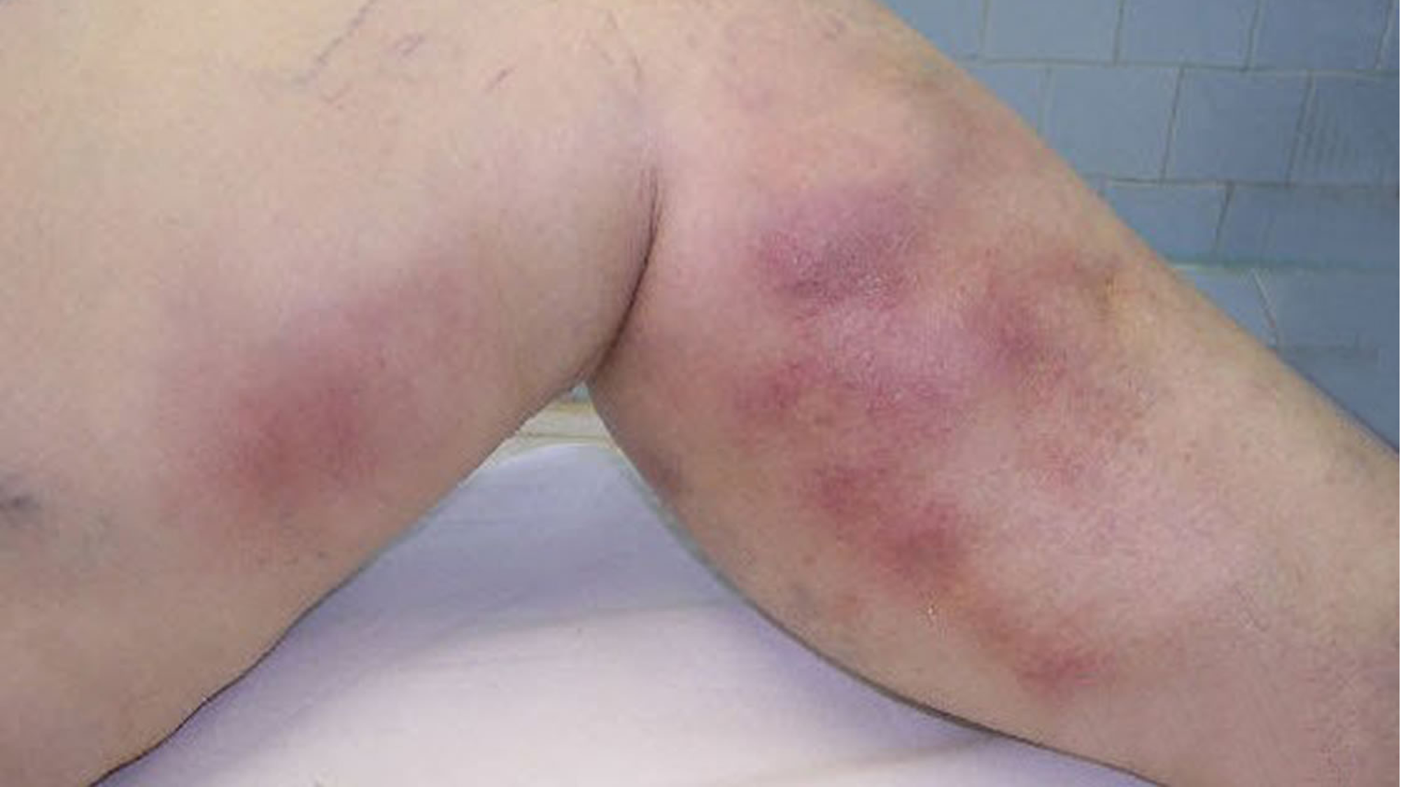 tromboflebitis